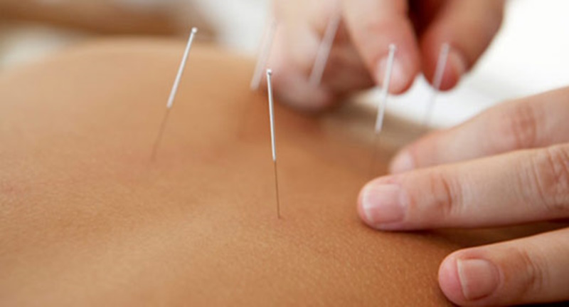 Acupuncture: Bringing the Body Back into Balance